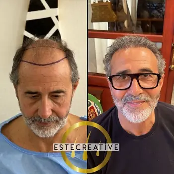 trapianto-capelli-albania-risultati-2