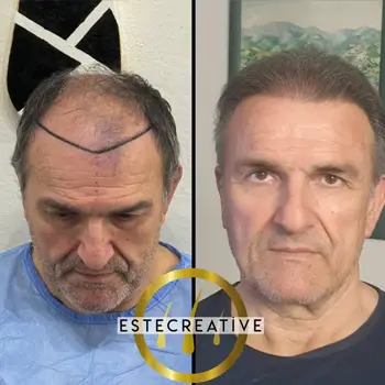 trapianto-capelli-albania-risultati-3