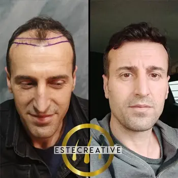 trapianto-capelli-albania-risultati-4