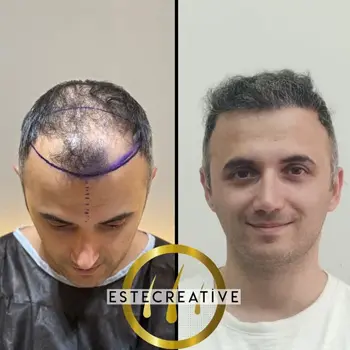 trapianto-capelli-albania-risultati