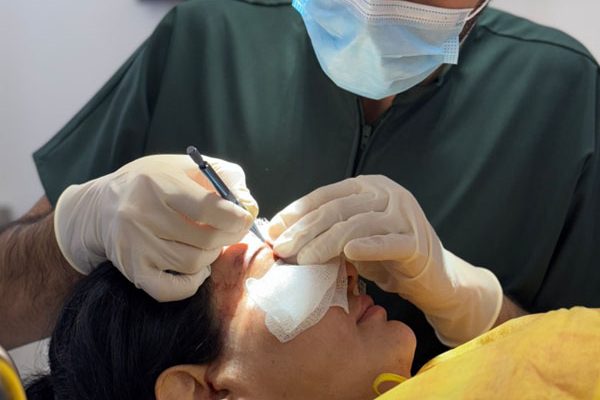 eyebrows transplant estecreative hair transplant in albania clinic